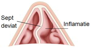 Inflamatia septului nazal