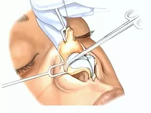 Rinoplastia prin metoda deschisa