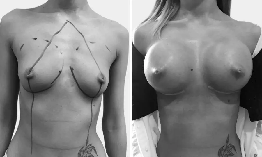 CAZ #1 - Implanturi mamare Mentor 475 cc inainte si la 4 zile dupa operatie