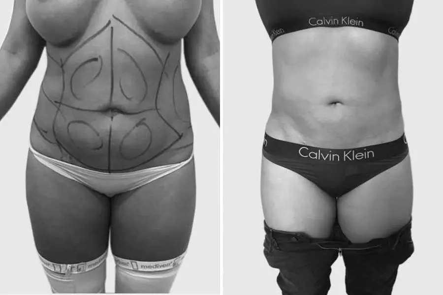 CAZ #1 - Liposuctie abdominala inainte si dupa operatie (poze frontale)