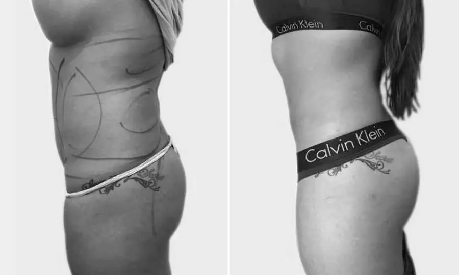 CAZ #1 Liposuctie abdominala inainte si dupa operatie (poze laterale)