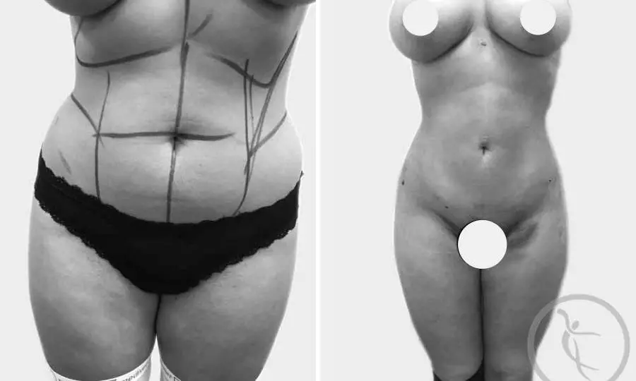 CAZ #2 - Lipoaspiratie abdominala inainte si dupa operatie (poze frontale)