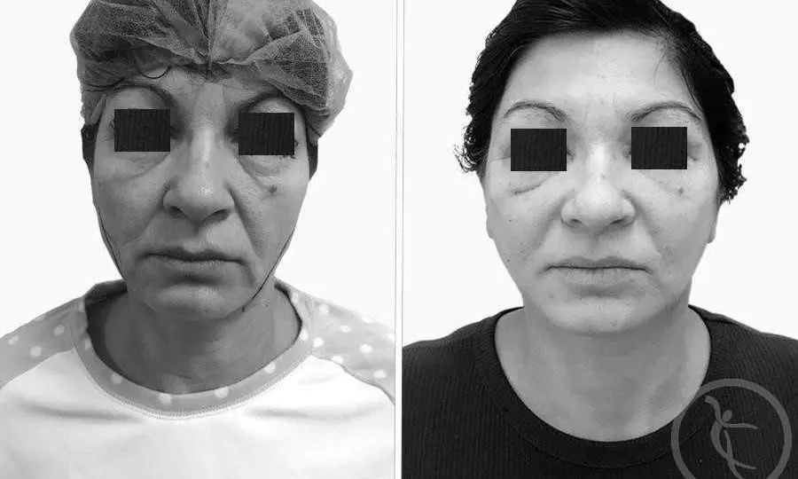 CAZ #1 Lifting facial si blefaroplastie completa (poze frontal)