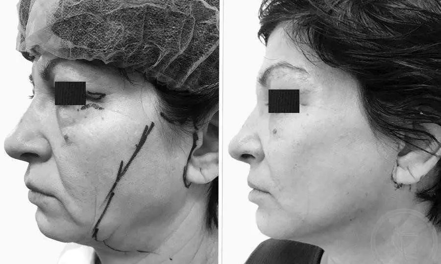 CAZ #1 Lifting facial si blefaroplastie completa (poze lateral)