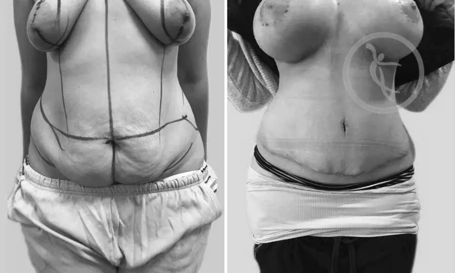 CAZ #2 Abdominoplastie cu lifting si implanturi mamare
