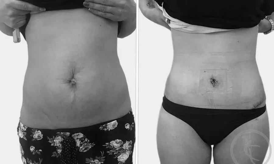 CAZ #3 Abdominoplastie totala cu mutare ombilic