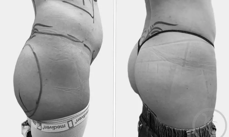 Caz #3 Lipoaspiratie cu transfer grasime proprie in fese (lateral)