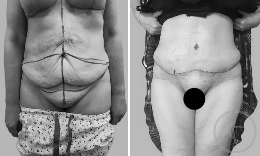 CAZ #1 Abdominoplastie totala cu mutare de ombilic