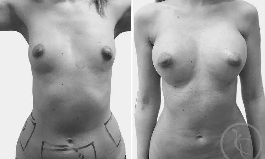 CAZ #1 Augmentare mamara cu grasime proprie din abdomen