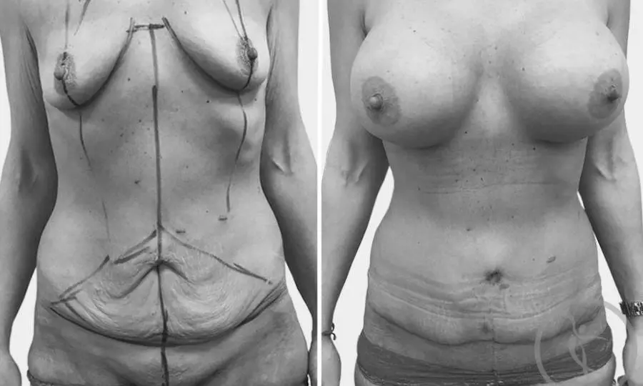 CAZ #4 Abdominoplastie si implant mamar din silicon
