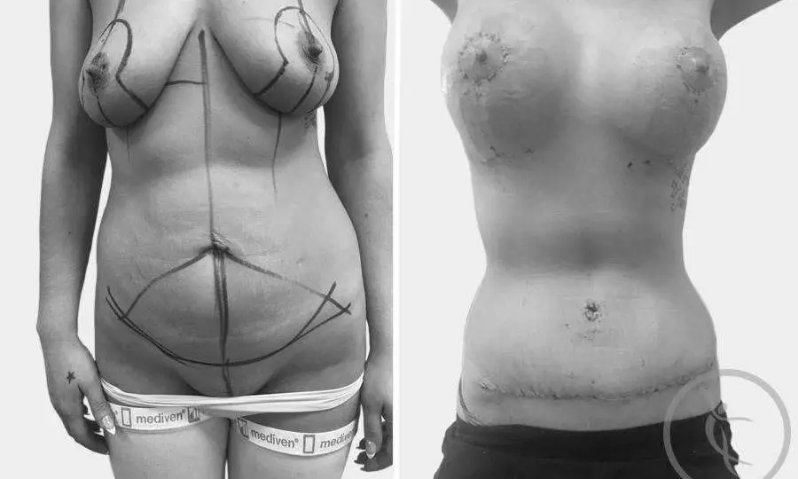 CAZ #5 Abdominoplastie si lifting cu implant (mutare ombilic si areole)