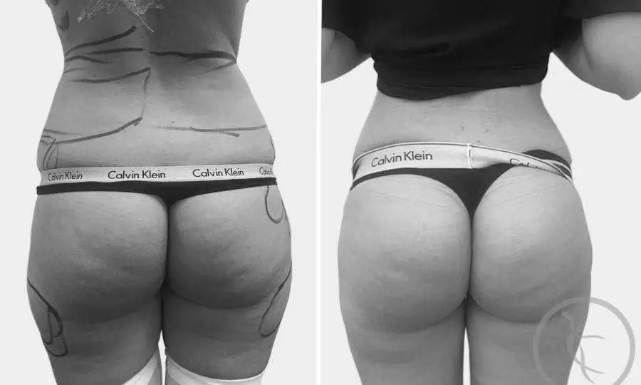 CAZ #7 Liposuctie coapse, flancuri, abdomen (spate)