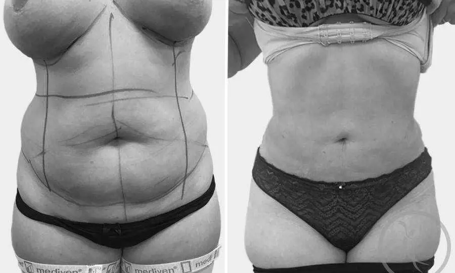 CAZ #9 Liposuctie clasica abdominala