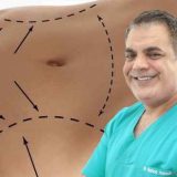 Abdominoplastie dupa cezariana