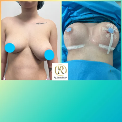 Caz implant mamar și lifting mamar 024