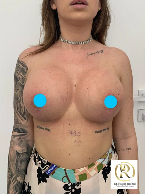 Caz implant mamar și lifting mamar 025