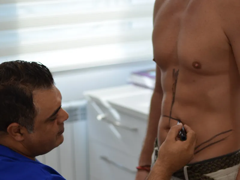 Dr. Rachad marchează abdomenul unui pacient înainte de liposucția abdominală