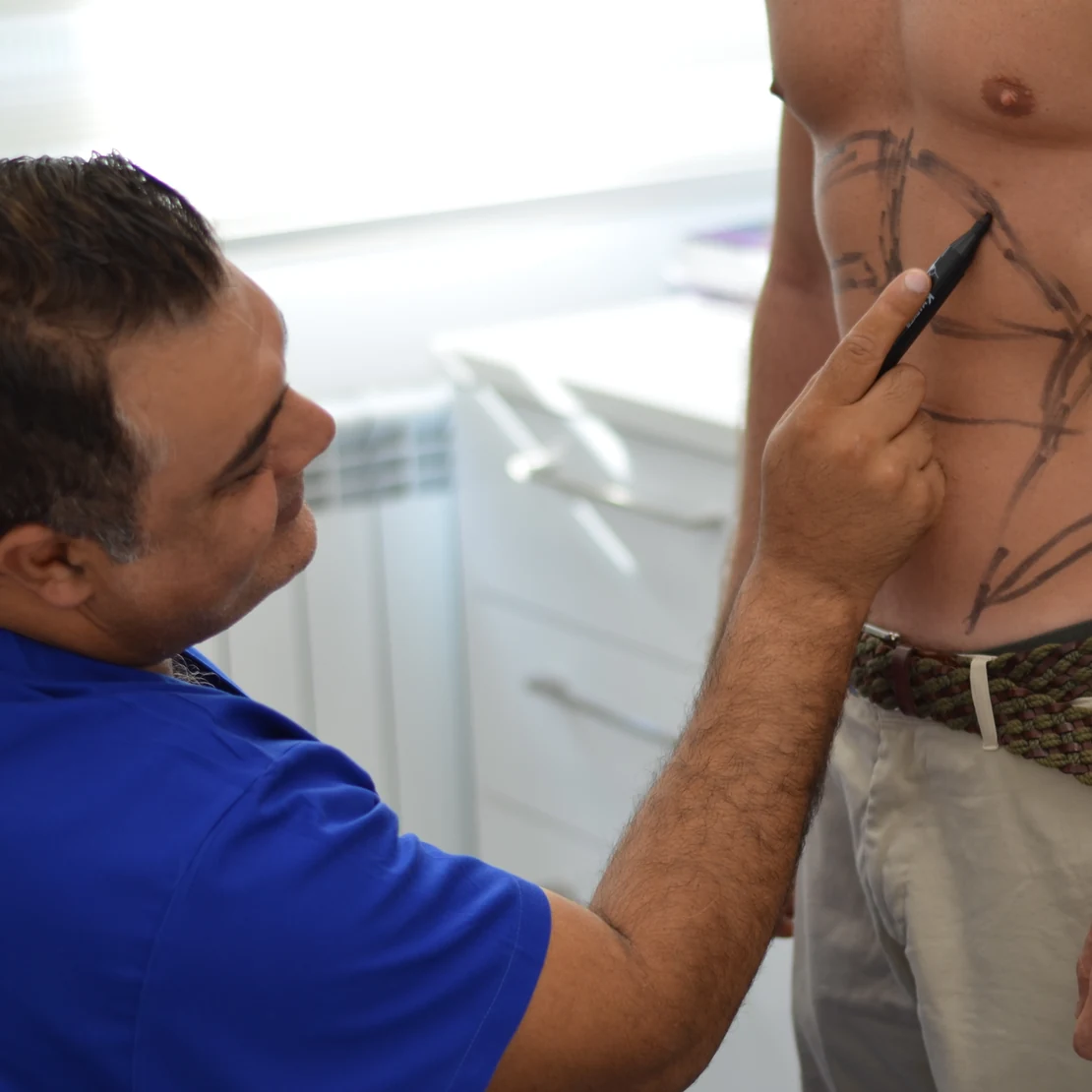 Dr. Rachad marchează zonele de liposucție pe abdomenul pacientului, înainte de operație
