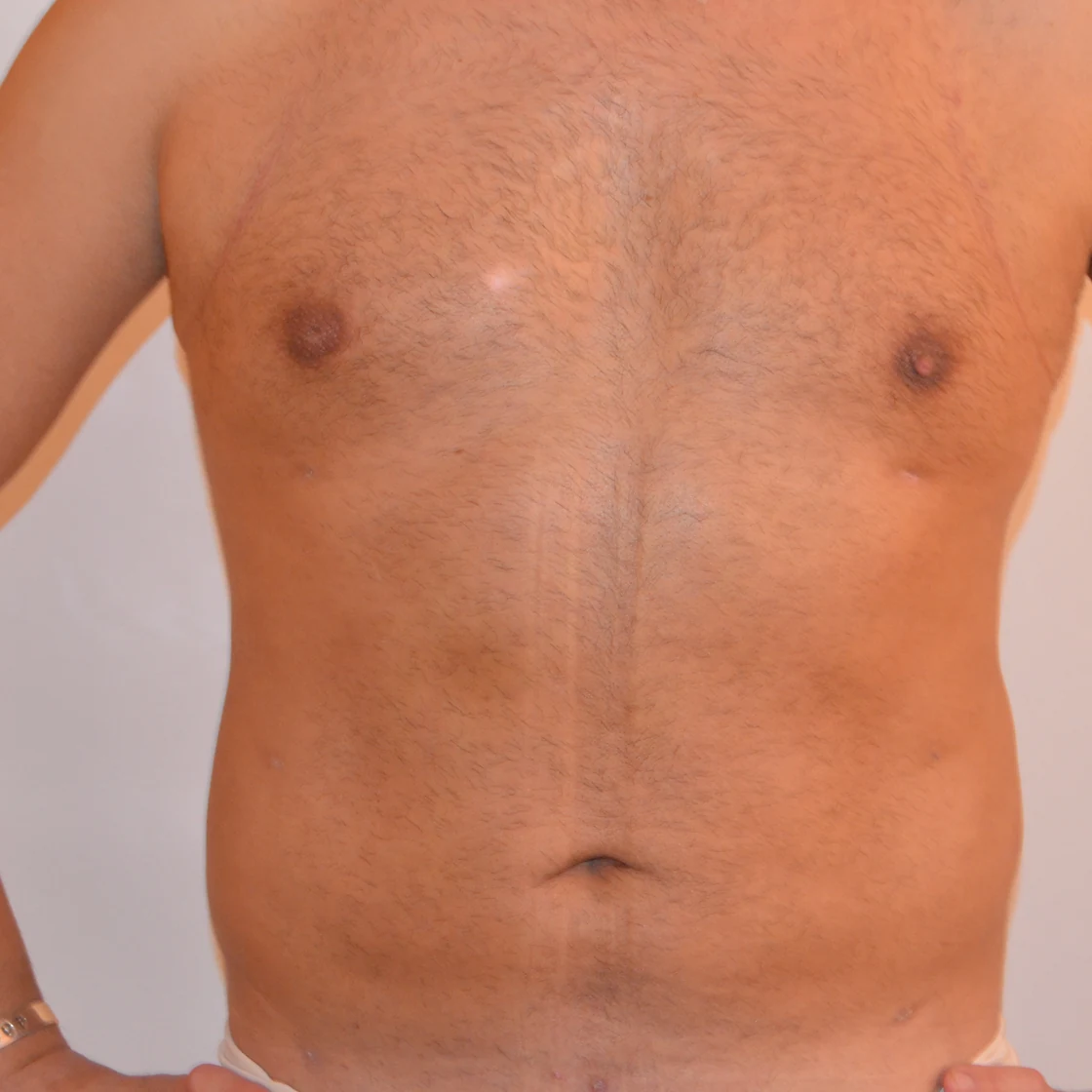 Abdomenul și flancurile unui pacient înainte de liposucție, zonele care se pot opera